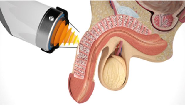 Diagram of low-intensity shockwave therapy for erectile dysfunction