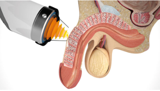 Diagram of low-intensity shockwave therapy for erectile dysfunction